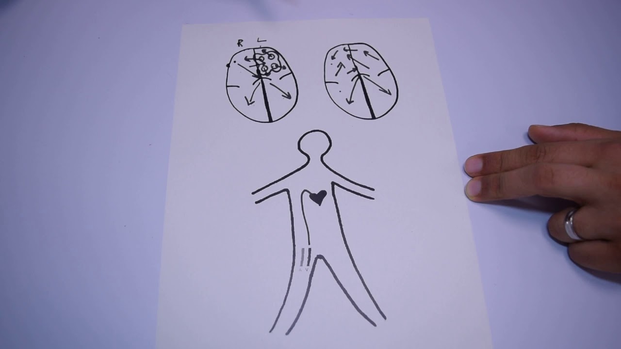 Atrial Fibrillation ablation