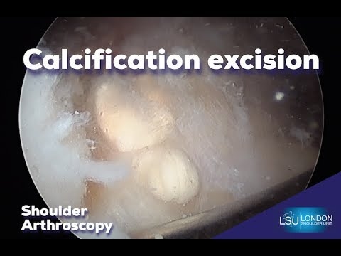 Arthroscopic Excision of Calcium
