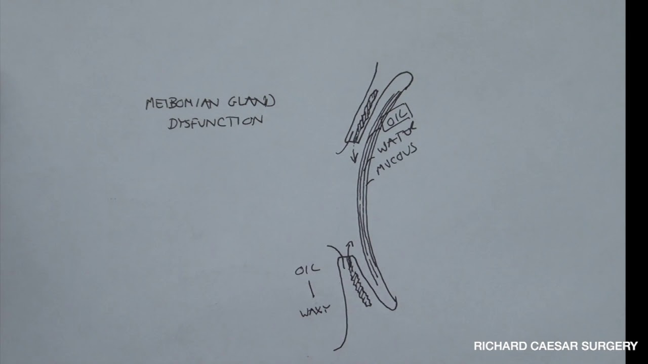 Dry Eye Explained. Why does my eye water if I have Dry Eye?