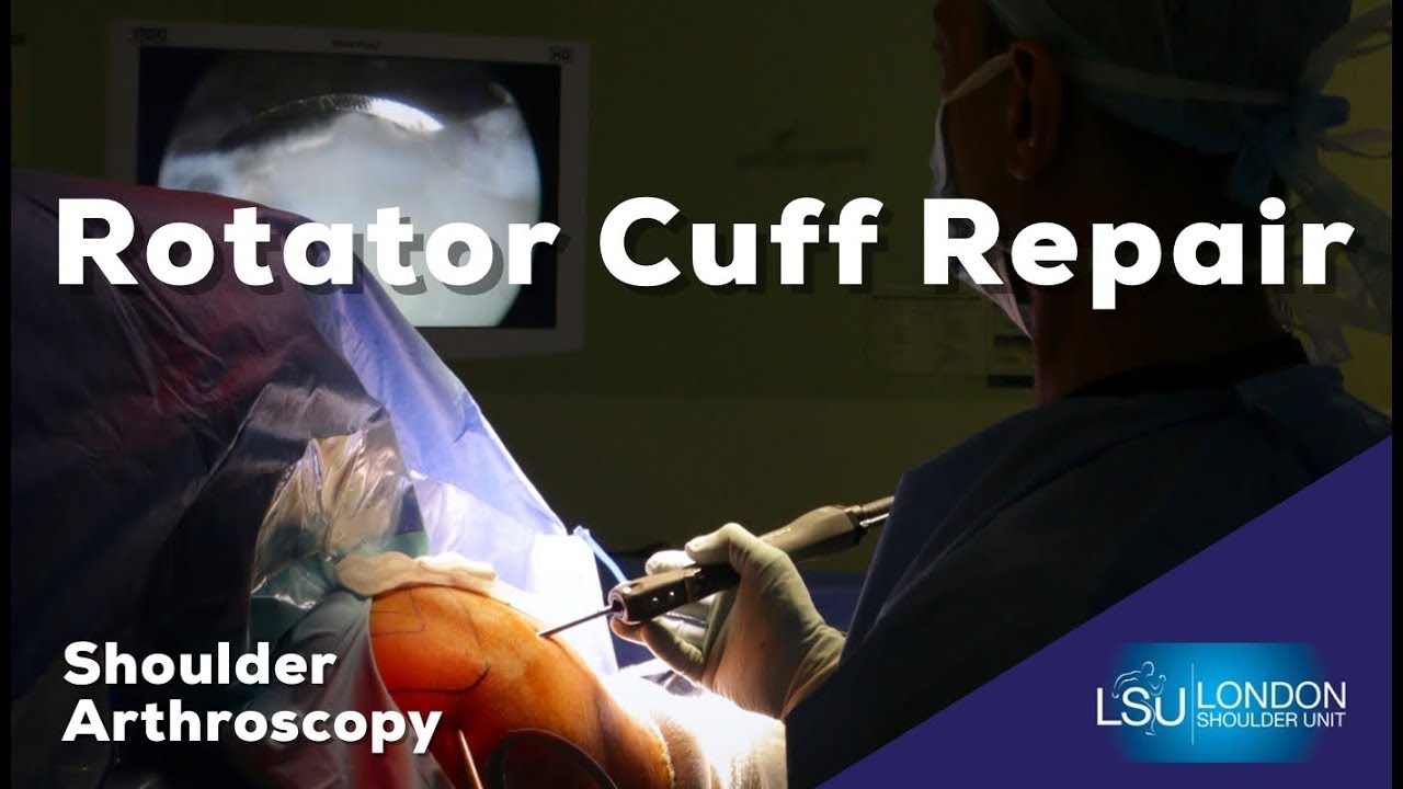 Arthroscopic Cuff Repair