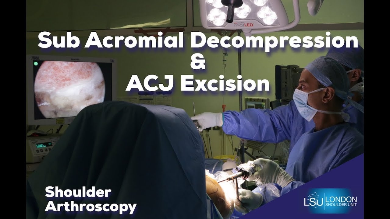 Arthroscopic ACJ Excision & Subacromial Decompression